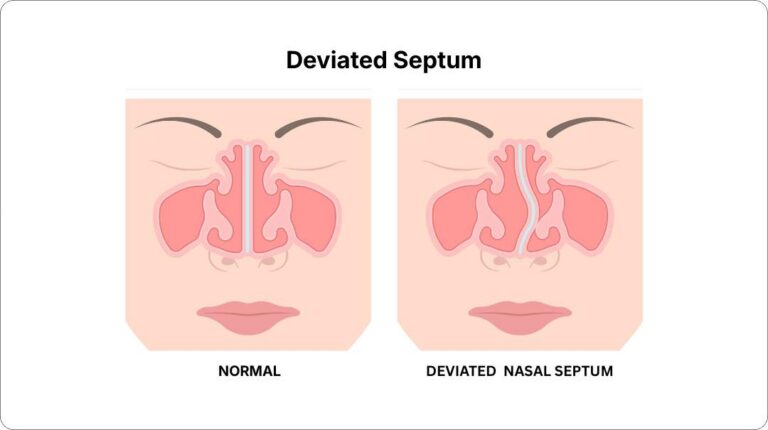 Deviated Septum Surgery in Los Angeles