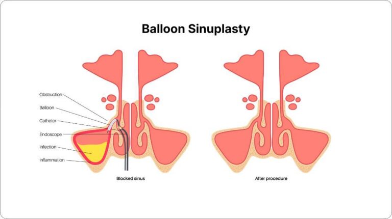 Balloon Sinuplasty Los Angeles | Dr. Zadeh