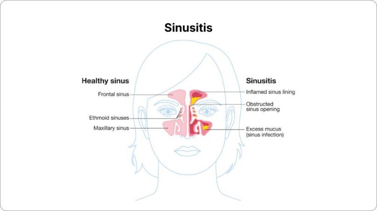 Sinusitis Treatment in Los Angeles